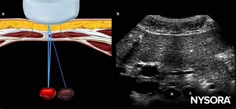 Ultrasound image artifacts explained - NYSORA