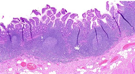 Histology Of Ileum Peyers Patches