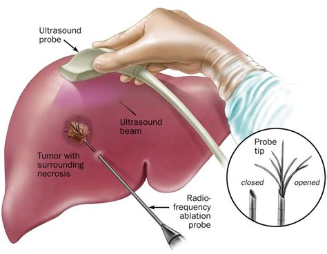 Liver Tumor Ablation – South Florida Sugical Oncology