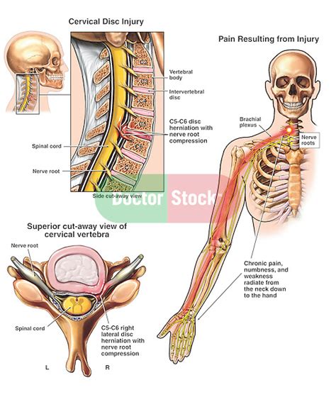 Spinal Cord - C5-6 Disc Herniation with Chronic Neurological Deficits ...