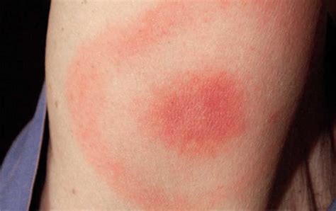 Erythema migrans causes, symptoms, diagnosis & treatment