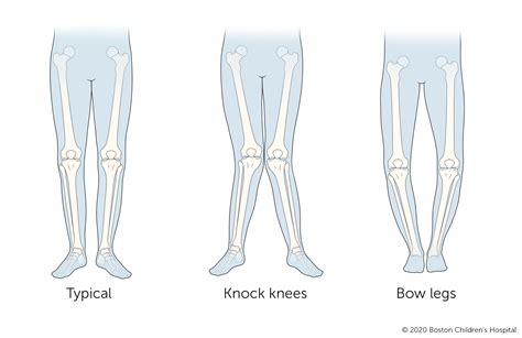 Gait And Its Abnormalities – NBKomputer