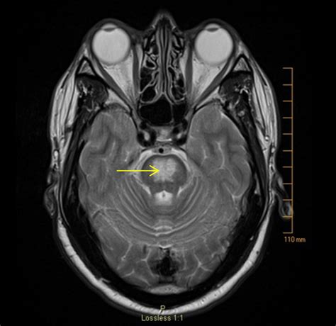 MRI brain T2 image demonstrating a symmetric hyperintense lesion in the ...