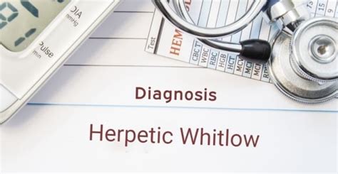 What is Herpetic Whitlow? - Facty Health