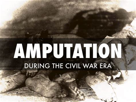 Civil War Era Amputation by Alicia Anthony