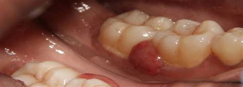 Oral Pyogenic Granuloma Tongue.