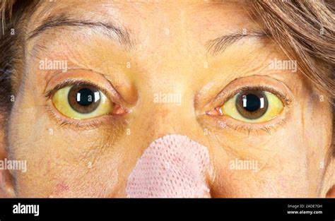 Kayser-Fleischer rings in eyes due to liver disease. Eyes of a 62-year-old woman with Kayser ...