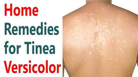 Top Natural Home Remedies For Tinea Versicolor - Health Blog