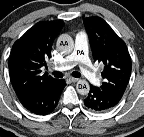 Saddle pulmonary embolism – Radiology Cases