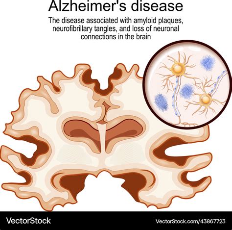 Alzheimers disease brain and neurons Royalty Free Vector