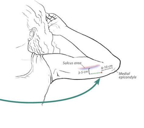 Inserting Implants | Family Planning