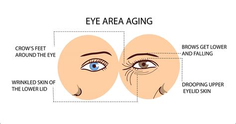 Under Eye Wrinkles - 5 Proven Ways to Reduce Fine Lines & Wrinkles