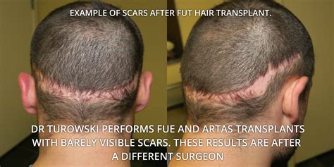 FUT Hair Transplant Before After Photos and Results