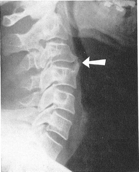 Cervical Osteophytes