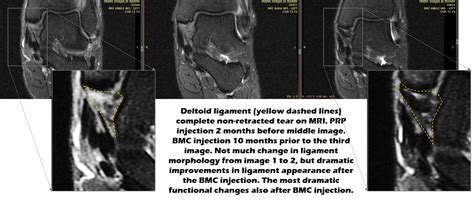 How to Heal a Torn Deltoid Ligament - Regenexx