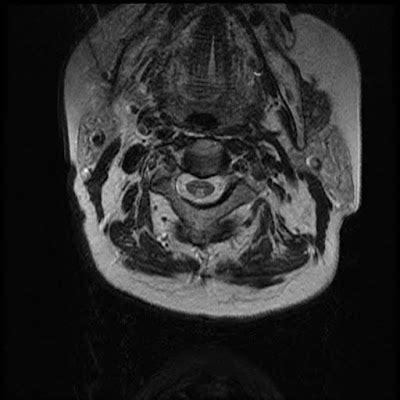 Radiology Cases: Subacute Combined Degeneration of the Spinal Cord