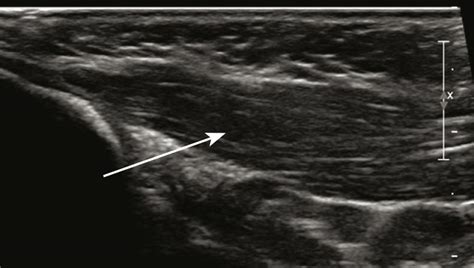 RACGP - Fibromatosis colli