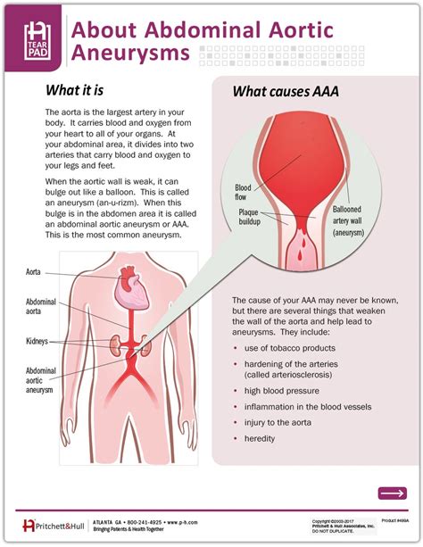 Abdominal Aortic Aneurysm Tearpad (50 sheets per pad) - Pritchett and Hull Nursing Cheat ...