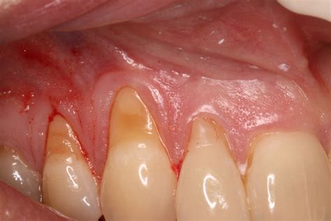 Receding Gums & Tooth Sensitivity - Ryan Lanman DDS, MSD