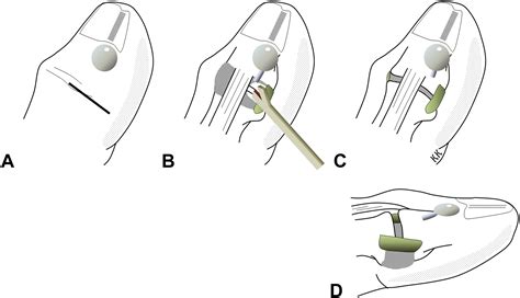 Total Dorsal Capsulectomy for the Treatment of Mucous Cysts - Journal ...