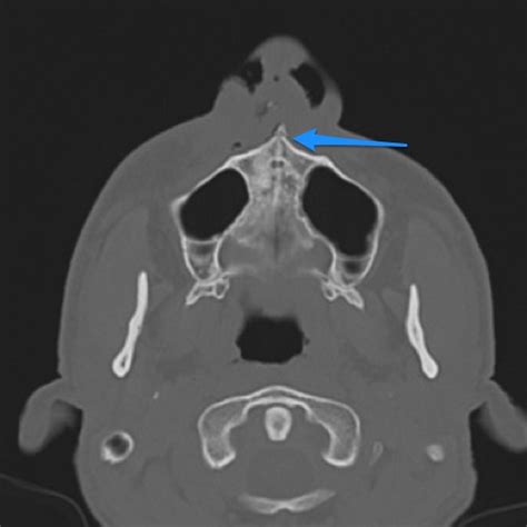 Anterior Nasal Spine Radiograph