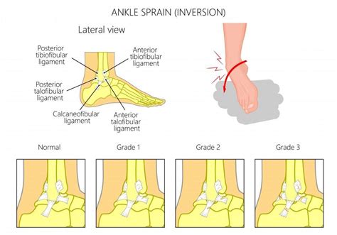 What is an Ankle Sprain?: Eugene Stautberg, MD: General Orthopedic Surgeon