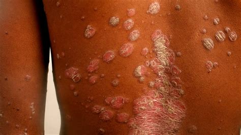 Hiv Skin Rash Symptoms