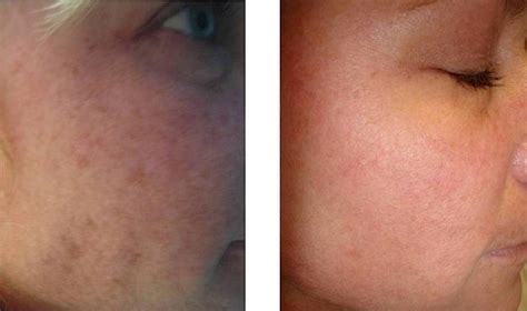 Intense Pulsed Light (IPL) for Acne Scars | Schweiger Dermatology