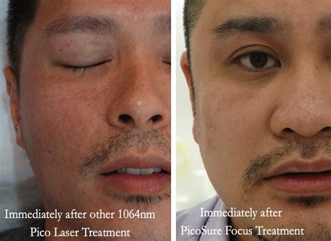 PicoSure Laser - A Gentler Alternative for Acne Scars | Dr. Siew Tuck Wah