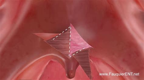 Furlow Palatoplasty (Double Opposing Z-plasty) to Treat VPI | Treats, Doubles, Abstract artwork