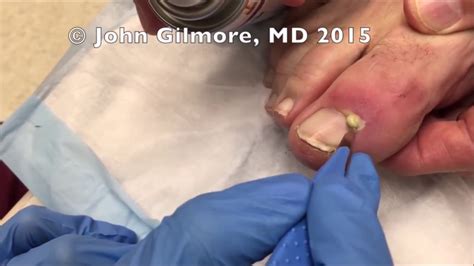 Toe Cyst Burst? Gonzo Operates on Dr. G's Paronychia - YouTube