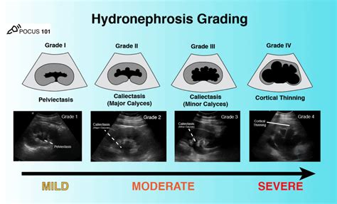 Renal Ultrasound Made Easy: Step-By-Step Guide in 2021 | Ultrasound ...