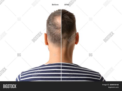 Man Before After Hair Image & Photo (Free Trial) | Bigstock