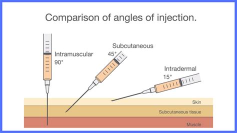 Progesterone Shots in IVF: What's It For (& 5 Tips You Need To Know) - Alex Robles, MD