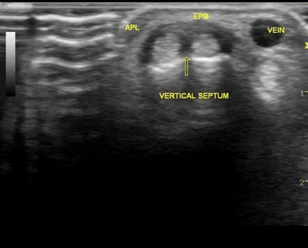 Tendinitis De Quervain Ultrasound