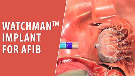 Watchman™Implant for AFib | Texas Cardiac Arrhythmia | Trusted Patient Education Platform