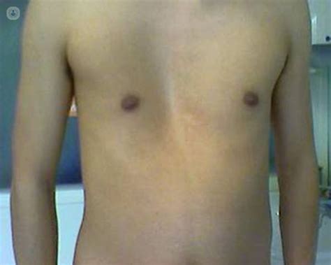 Pectus : Pectus Carinatum Case Histories : This causes a depression of ...