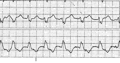 ECG Rhythms: WCT - VT or Aberrancy?