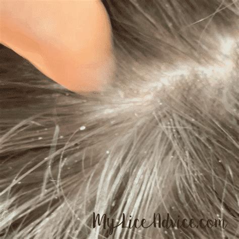 Lice vs Dandruff - 7 Key Differences Between Lice Eggs and Dandruff