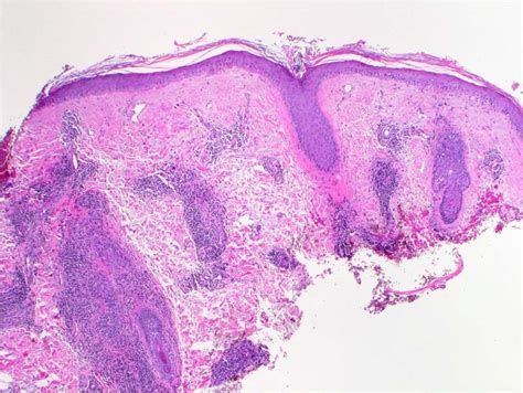 Discoid Lupus Erythematosus Histopathology