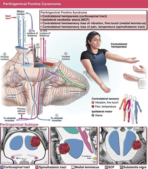 Cavernous Malformation | Barrow Neurological Institute