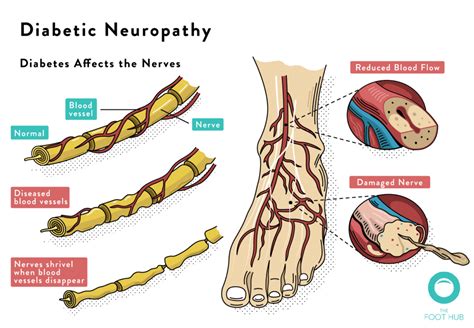 Diabetic Foot Assessment | The Foot Hub | Diabetic Podiatrist