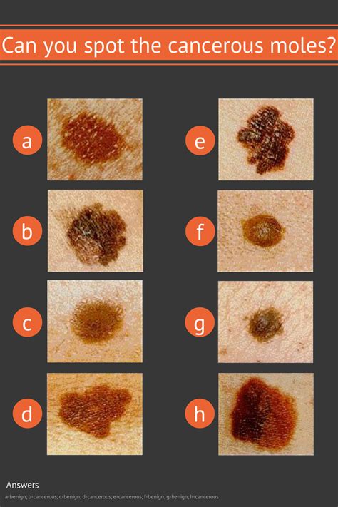 iDoc24 – Dermatologia en línea Cómo detectar un lunar canceroso