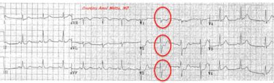 Posterior MI ECG | ALiEM