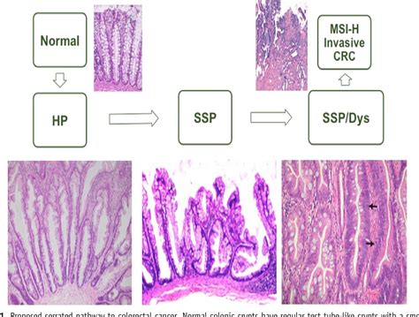 Sessile Serrated Polyps And Colon Cancer Prevention - CancerWalls