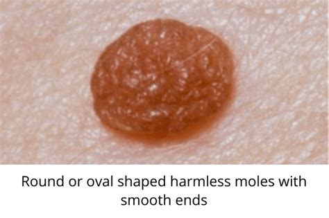 Skin Moles to Worry About – A Complete Guide With Skin Moles Pictures