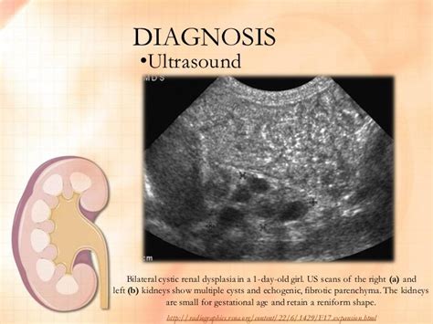 Renal Hypoplasia FINAL OUTPUT by Nica Valencia