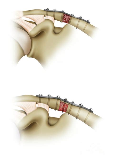 Clavicle Fracture Repair Surgery Photograph by Maurizio De Angelis/science Photo Library