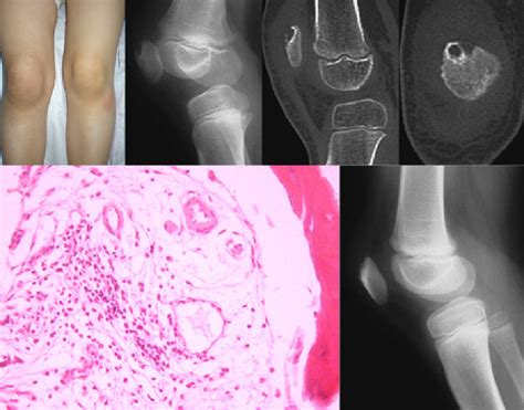 Clinical and imaging appearance of a 6-year-old girl who presented with... | Download Scientific ...