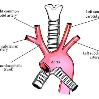 (PDF) The Aberrant Right Subclavian Artery (Arteria Lusoria): The Morphological and Clinical ...